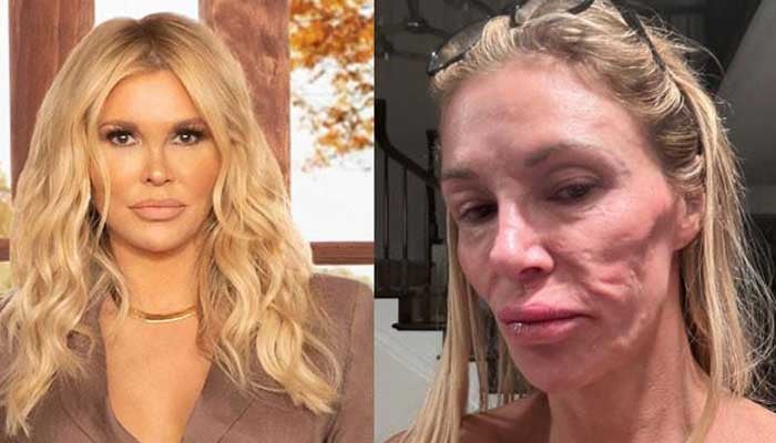 Brandi Glanville Speaks Out on Facial Disfigurement Battle