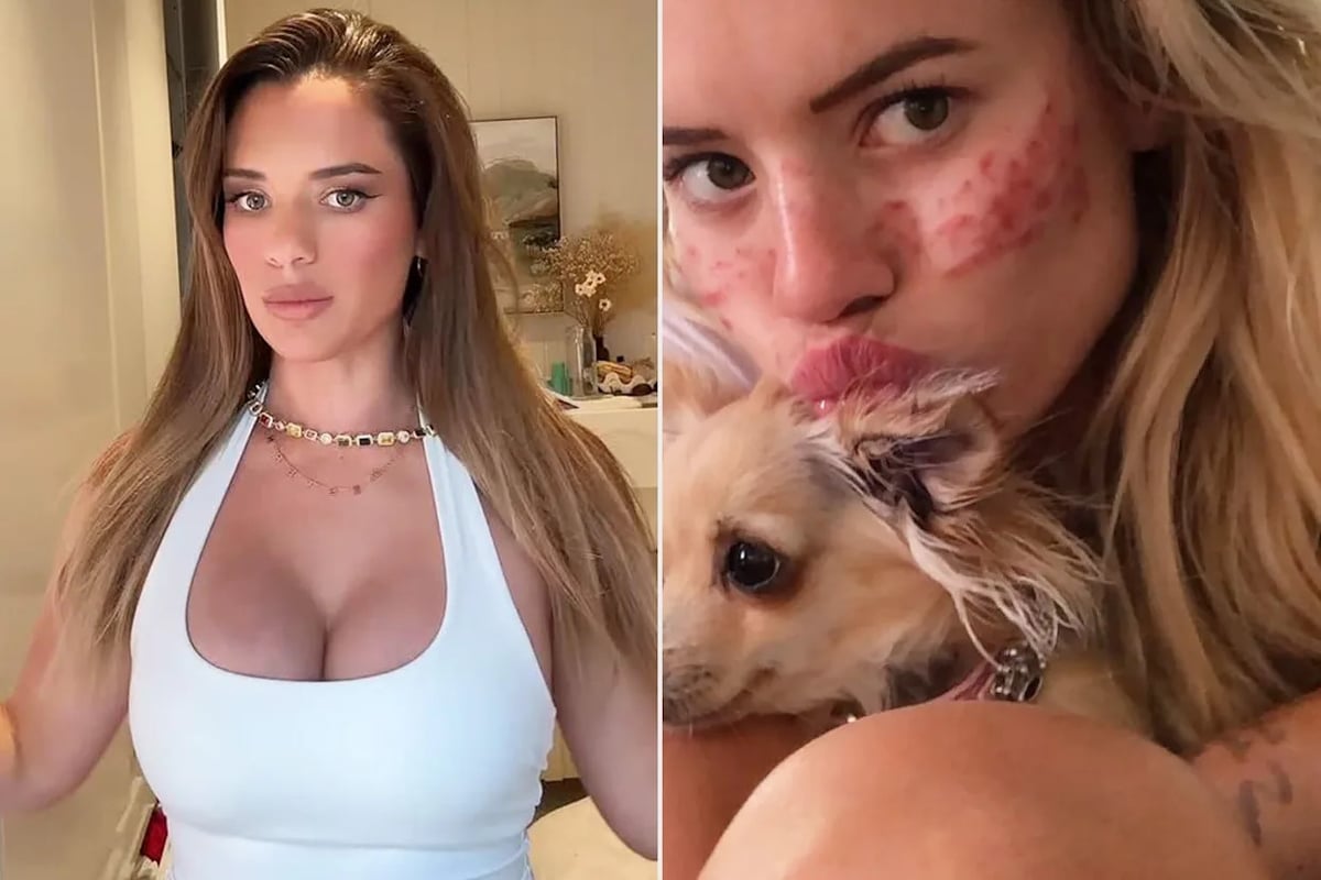 Mom, 26, Says She Is Reversing Cosmetic Work That Made Her Sick