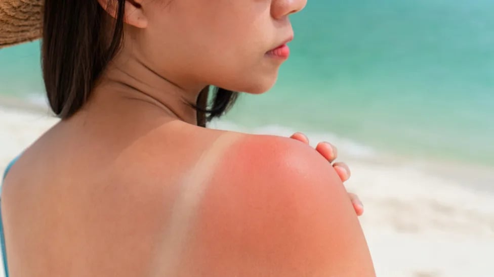 Study Flags Top Vacation Spot Where Sunburn Risk Is Highest