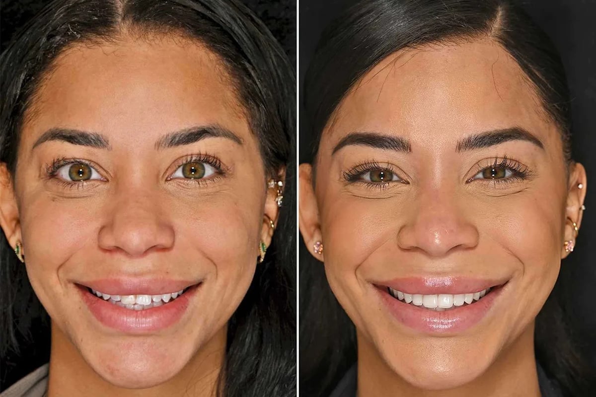 Love Island's Amaya Espinal Debuts Veneers and Boosts Confidence