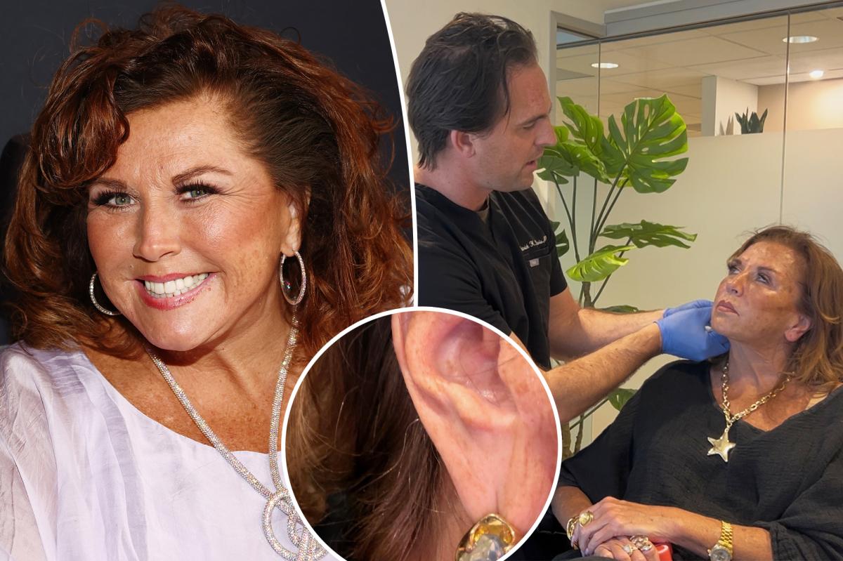 Abby Lee Miller Reveals $1K Ear Rejuvenation Results